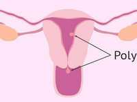 孕初期hcg下降了一定胎停吗？
